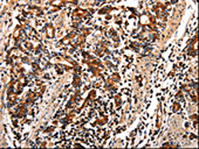 The image on the left is immunohistochemistry of paraffin-embedded Human stomach cancer tissue using CSB-PA143118(TTR Antibody) at dilution 1/10, on the right is treated with fusion protein. (Original magnification: ×200)