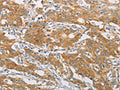 The image on the left is immunohistochemistry of paraffin-embedded Human gastic cancer tissue using CSB-PA143333(FARSB Antibody) at dilution 1/20, on the right is treated with fusion protein. (Original magnification: ×200)