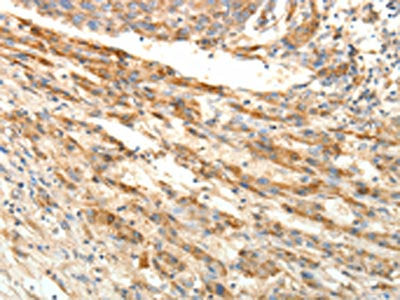 The image on the left is immunohistochemistry of paraffin-embedded Human liver cancer tissue using CSB-PA143745(SIRT4 Antibody) at dilution 1/25, on the right is treated with fusion protein. (Original magnification: ×200)