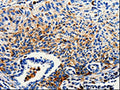 The image on the left is immunohistochemistry of paraffin-embedded Human lung cancer tissue using CSB-PA144023(CTSZ Antibody) at dilution 1/25, on the right is treated with fusion protein. (Original magnification: ×200)