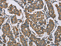 The image on the left is immunohistochemistry of paraffin-embedded Human breast cancer tissue using CSB-PA144078(HDAC6 Antibody) at dilution 1/50, on the right is treated with fusion protein. (Original magnification: ×200)