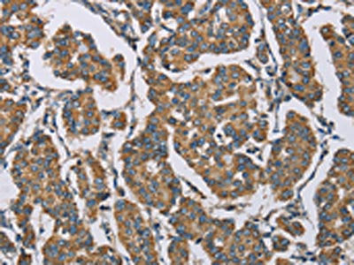 The image on the left is immunohistochemistry of paraffin-embedded Human breast cancer tissue using CSB-PA144078(HDAC6 Antibody) at dilution 1/50, on the right is treated with fusion protein. (Original magnification: ×200)