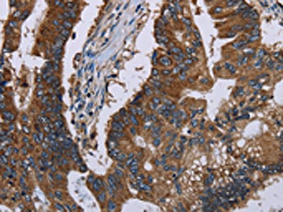 The image on the left is immunohistochemistry of paraffin-embedded Human colon cancer tissue using CSB-PA144936(CLDND1 Antibody) at dilution 1/40, on the right is treated with fusion protein. (Original magnification: ×200)