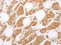 The image on the left is immunohistochemistry of paraffin-embedded Human breast cancer tissue using CSB-PA145488(LEPR Antibody) at dilution 1/25, on the right is treated with synthetic peptide. (Original magnification: ×200)