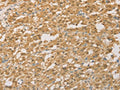 The image on the left is immunohistochemistry of paraffin-embedded Human thyroid cancer tissue using CSB-PA145596(PGK2 Antibody) at dilution 1/50, on the right is treated with fusion protein. (Original magnification: ×200)