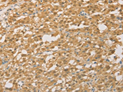 The image on the left is immunohistochemistry of paraffin-embedded Human thyroid cancer tissue using CSB-PA145596(PGK2 Antibody) at dilution 1/50, on the right is treated with fusion protein. (Original magnification: ×200)