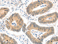 The image on the left is immunohistochemistry of paraffin-embedded Human colon cancer tissue using CSB-PA145666(MAGED1 Antibody) at dilution 1/30, on the right is treated with fusion protein. (Original magnification: ×200)