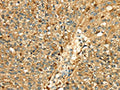 The image on the left is immunohistochemistry of paraffin-embedded Human breast cancer tissue using CSB-PA145926(CTSH Antibody) at dilution 1/50, on the right is treated with fusion protein. (Original magnification: ×200)