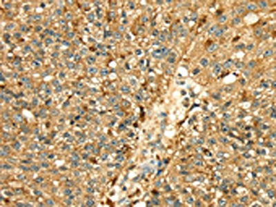 The image on the left is immunohistochemistry of paraffin-embedded Human breast cancer tissue using CSB-PA145926(CTSH Antibody) at dilution 1/50, on the right is treated with fusion protein. (Original magnification: ×200)