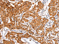 The image on the left is immunohistochemistry of paraffin-embedded Human lung cancer tissue using CSB-PA146040(TRAF5 Antibody) at dilution 1/30, on the right is treated with fusion protein. (Original magnification: ×200)