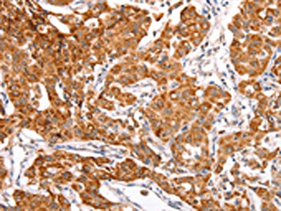The image on the left is immunohistochemistry of paraffin-embedded Human lung cancer tissue using CSB-PA146040(TRAF5 Antibody) at dilution 1/30, on the right is treated with fusion protein. (Original magnification: ×200)