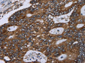 The image on the left is immunohistochemistry of paraffin-embedded Human colon cancer tissue using CSB-PA146152(GOLGA2 Antibody) at dilution 1/60, on the right is treated with fusion protein. (Original magnification: ×200)