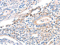 The image on the left is immunohistochemistry of paraffin-embedded Human gastric cancer tissue using CSB-PA146937(TWF2 Antibody) at dilution 1/40, on the right is treated with fusion protein. (Original magnification: ×200)