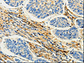 The image on the left is immunohistochemistry of paraffin-embedded Human lung cancer tissue using CSB-PA147089(CAP1 Antibody) at dilution 1/25, on the right is treated with fusion protein. (Original magnification: ×200)