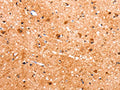 The image on the left is immunohistochemistry of paraffin-embedded Human brain tissue using CSB-PA147566(FABP7 Antibody) at dilution 1/22, on the right is treated with fusion protein. (Original magnification: ×200)