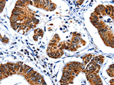The image on the left is immunohistochemistry of paraffin-embedded Human colon cancer tissue using CSB-PA147596(GSK3A Antibody) at dilution 1/50, on the right is treated with synthetic peptide. (Original magnification: ×200)