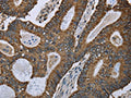 The image on the left is immunohistochemistry of paraffin-embedded Human colon cancer tissue using CSB-PA147812(GOT2 Antibody) at dilution 1/50, on the right is treated with fusion protein. (Original magnification: ×200)