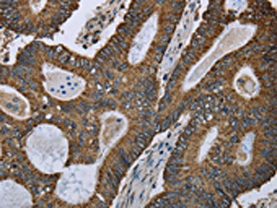 The image on the left is immunohistochemistry of paraffin-embedded Human colon cancer tissue using CSB-PA147812(GOT2 Antibody) at dilution 1/50, on the right is treated with fusion protein. (Original magnification: ×200)