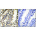 Immunohistochemistry analysis of paraffin-embedded human colon carcinoma tissue, using TNFA antibody.