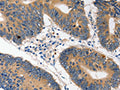 The image on the left is immunohistochemistry of paraffin-embedded Human colon cancer tissue using CSB-PA147894(HDC Antibody) at dilution 1/10, on the right is treated with fusion protein. (Original magnification: ×200)