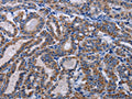 The image on the left is immunohistochemistry of paraffin-embedded Human thyroid cancer tissue using CSB-PA147947(GNAS Antibody) at dilution 1/20, on the right is treated with fusion protein. (Original magnification: ×200)