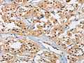 The image on the left is immunohistochemistry of paraffin-embedded Human thyroid cancer tissue using CSB-PA148420(CARD8 Antibody) at dilution 1/40, on the right is treated with fusion protein. (Original magnification: ×200)