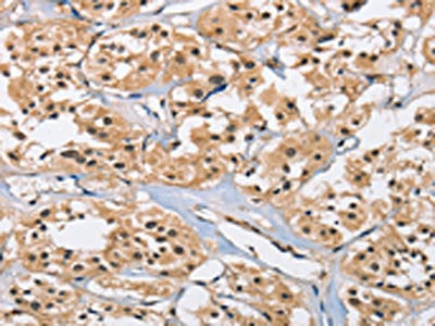 The image on the left is immunohistochemistry of paraffin-embedded Human thyroid cancer tissue using CSB-PA148420(CARD8 Antibody) at dilution 1/40, on the right is treated with fusion protein. (Original magnification: ×200)