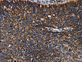 The image on the left is immunohistochemistry of paraffin-embedded Human cervical cancer tissue using CSB-PA148538(IDH2 Antibody) at dilution 1/60, on the right is treated with fusion protein. (Original magnification: ×200)