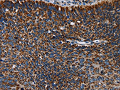 The image on the left is immunohistochemistry of paraffin-embedded Human cervical cancer tissue using CSB-PA148538(IDH2 Antibody) at dilution 1/60, on the right is treated with fusion protein. (Original magnification: ×200)