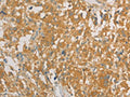 The image on the left is immunohistochemistry of paraffin-embedded Human thyroid cancer tissue using CSB-PA148761(PRPSAP1 Antibody) at dilution 1/80, on the right is treated with fusion protein. (Original magnification: ×200)