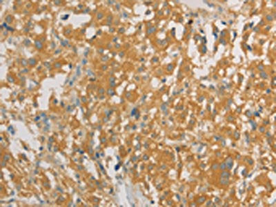 The image on the left is immunohistochemistry of paraffin-embedded Human thyroid cancer tissue using CSB-PA148761(PRPSAP1 Antibody) at dilution 1/80, on the right is treated with fusion protein. (Original magnification: ×200)