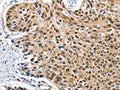 The image on the left is immunohistochemistry of paraffin-embedded Human esophagus cancer tissue using CSB-PA148981(ITGAM Antibody) at dilution 1/20, on the right is treated with synthetic peptide. (Original magnification: ×200)