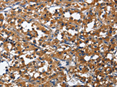 The image on the left is immunohistochemistry of paraffin-embedded Human thyroid cancer tissue using CSB-PA149291(CD27 Antibody) at dilution 1/60, on the right is treated with fusion protein. (Original magnification: ×200)
