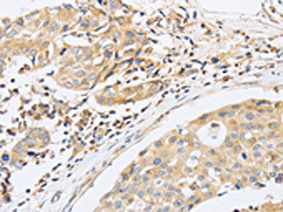The image on the left is immunohistochemistry of paraffin-embedded Human breast cancer tissue using CSB-PA149552(ABHD5 Antibody) at dilution 1/15, on the right is treated with fusion protein. (Original magnification: ×200)