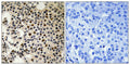 Immunohistochemical analysis of paraffin-embedded human breast carcinoma tissue, using PAK2 (Phospho-Ser197) antibody (left)or the same antibody preincubated with blocking peptide (right).
