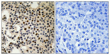 Immunohistochemical analysis of paraffin-embedded human breast carcinoma tissue, using PAK2 (Phospho-Ser197) antibody (left)or the same antibody preincubated with blocking peptide (right).
