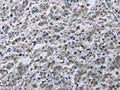 The image on the left is immunohistochemistry of paraffin-embedded Human liver cancer tissue using CSB-PA150749(FES Antibody) at dilution 1/35, on the right is treated with fusion protein. (Original magnification: ×200)
