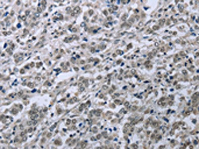 The image on the left is immunohistochemistry of paraffin-embedded Human liver cancer tissue using CSB-PA150749(FES Antibody) at dilution 1/35, on the right is treated with fusion protein. (Original magnification: ×200)