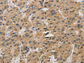 The image on the left is immunohistochemistry of paraffin-embedded Human liver cancer tissue using CSB-PA151075(DDIT4 Antibody) at dilution 1/30, on the right is treated with fusion protein. (Original magnification: ×200)