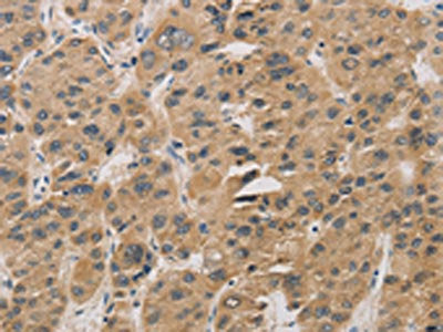 The image on the left is immunohistochemistry of paraffin-embedded Human liver cancer tissue using CSB-PA151075(DDIT4 Antibody) at dilution 1/30, on the right is treated with fusion protein. (Original magnification: ×200)