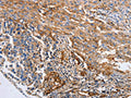 The image on the left is immunohistochemistry of paraffin-embedded Human liver cancer tissue using CSB-PA151172(CD151 Antibody) at dilution 1/10, on the right is treated with fusion protein. (Original magnification: ×200)