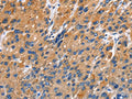 The image on the left is immunohistochemistry of paraffin-embedded Human liver cancer tissue using CSB-PA151323(EDN3 Antibody) at dilution 1/40, on the right is treated with fusion protein. (Original magnification: ×200)