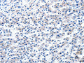 The image on the left is immunohistochemistry of paraffin-embedded Human liver cancer tissue using CSB-PA151818(AIMP2 Antibody) at dilution 1/25, on the right is treated with fusion protein. (Original magnification: ×200)