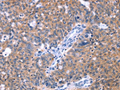 The image on the left is immunohistochemistry of paraffin-embedded Human ovarian cancer tissue using CSB-PA151926(ZNF395 Antibody) at dilution 1/40, on the right is treated with synthetic peptide. (Original magnification: ×200)