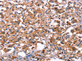 The image on the left is immunohistochemistry of paraffin-embedded Human thyroid cancer tissue using CSB-PA152513(LILRB1 Antibody) at dilution 1/30, on the right is treated with fusion protein. (Original magnification: ×200)