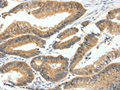 The image on the left is immunohistochemistry of paraffin-embedded Human colon cancer tissue using CSB-PA152593(MDK Antibody) at dilution 1/60, on the right is treated with fusion protein. (Original magnification: ×200)