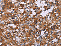 The image on the left is immunohistochemistry of paraffin-embedded Human thyroid cancer tissue using CSB-PA152806(MAPK1/MAPK3 Antibody) at dilution 1/30, on the right is treated with synthetic peptide. (Original magnification: ×200)