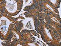 The image on the left is immunohistochemistry of paraffin-embedded Human colon cancer tissue using CSB-PA153165(GH2 Antibody) at dilution 1/60, on the right is treated with fusion protein. (Original magnification: ×200)