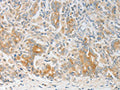 The image on the left is immunohistochemistry of paraffin-embedded Human gastic cancer tissue using CSB-PA153268(CALCR Antibody) at dilution 1/20, on the right is treated with fusion protein. (Original magnification: ×200)