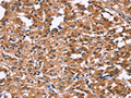 The image on the left is immunohistochemistry of paraffin-embedded Human thyroid cancer tissue using CSB-PA153505(DKK4 Antibody) at dilution 1/20, on the right is treated with fusion protein. (Original magnification: ×200)